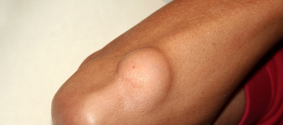 LIPOMA 2 30 liposoma