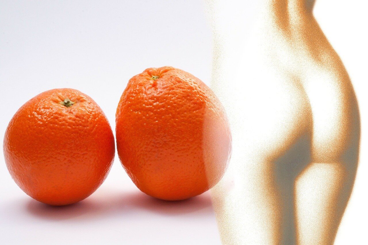 CELLULITE E ADIPOSITA' LOCALIZZATA 2 cellulite - buccia arancia