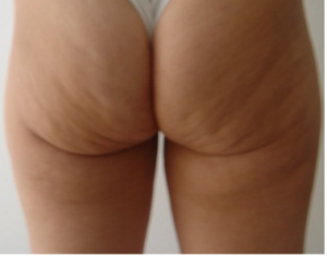 CELLULITE E ADIPOSITA' LOCALIZZATA 7 cellulite 2