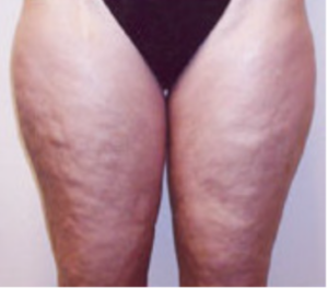 CELLULITE E ADIPOSITA' LOCALIZZATA 8 cellulite 3