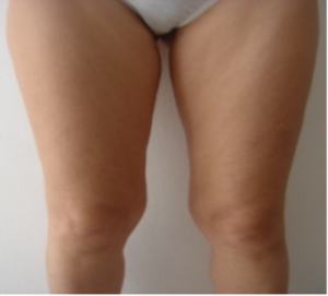CELLULITE E ADIPOSITA' LOCALIZZATA 9 cellulite 4