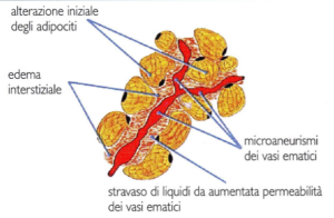 CELLULITE E ADIPOSITA' LOCALIZZATA 1 cellulite stadio - 1