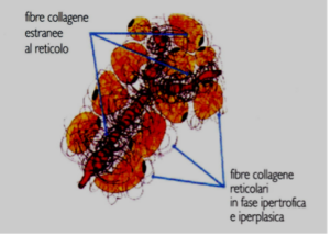 CELLULITE E ADIPOSITA' LOCALIZZATA 3 cellulite stadio - 2